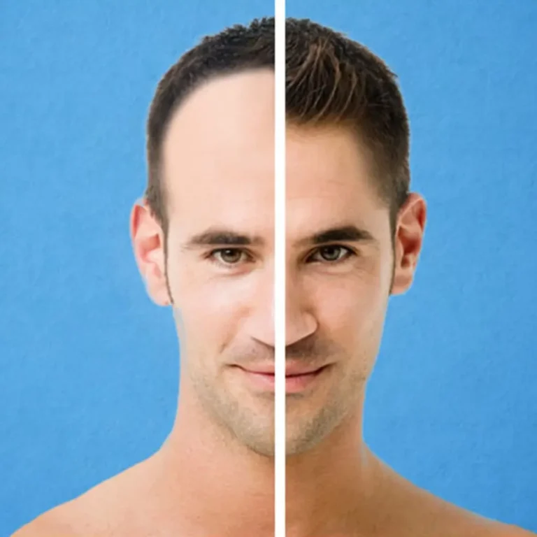 Hair transplant
